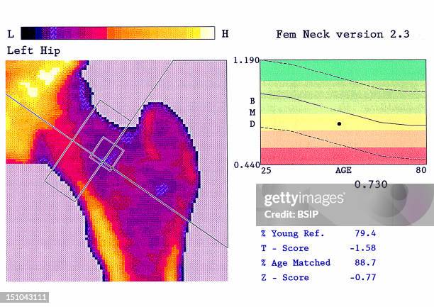 Dxa Scan Photos and Premium High Res Pictures - Getty Images