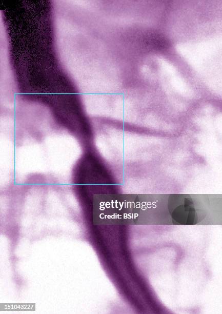 Stenosis Of The Left Iliac Artery Excess Of Cholestorol Deposits. Angiogram.