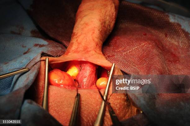 Photo Essay At Lyon Hospital. Department Of Urology. Surgical Treatment Of Erectile Dysfunction With A Penile Prosthesis.