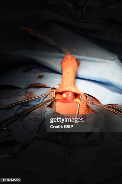 Photo Essay At Lyon Hospital. Department Of Urology. Surgical Treatment Of Erectile Dysfunction With A Penile Prosthesis.