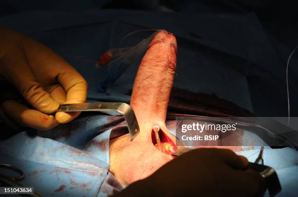 Photo Essay At Lyon Hospital. Department Of Urology. Surgical Treatment Of Erectile Dysfunction With A Penile Prosthesis. Test Of Erection With...