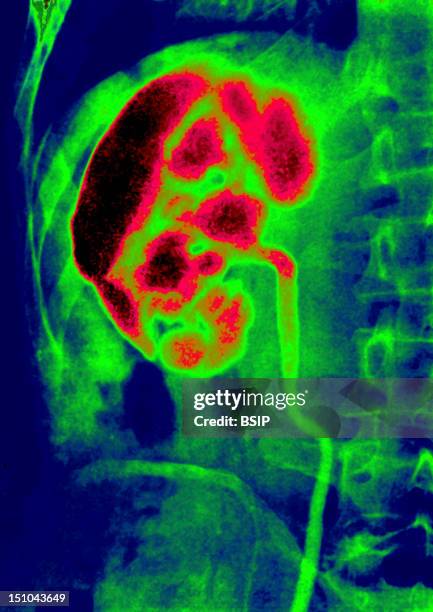 Ascending Nephritis By Microbial Urinary Infection, Visualized By An Urography Of The Right Kidney.