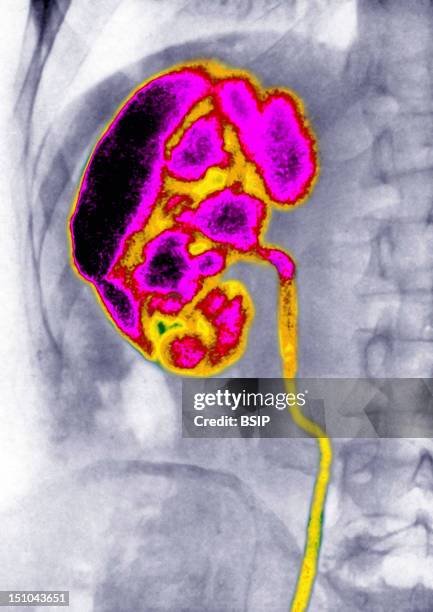 Ascending Nephritis By Microbial Urinary Infection, Visualized By An Urography Of The Right Kidney.