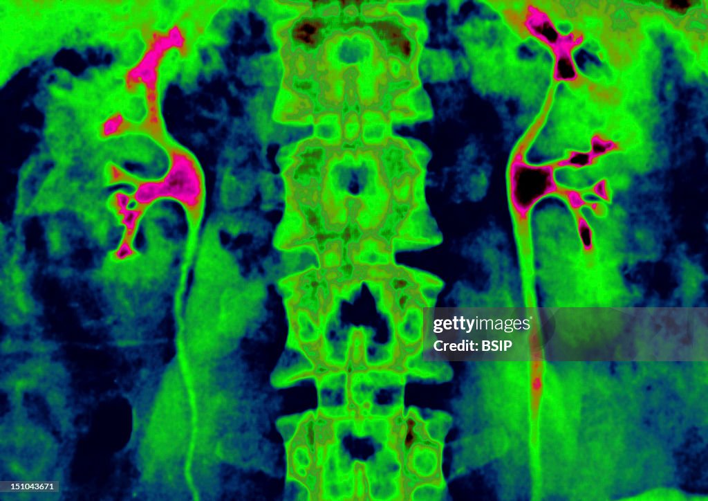 Kidney, X-Ray