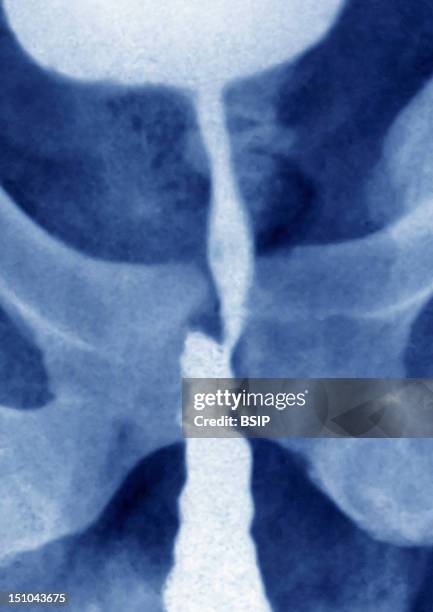 Traumatic Stenosis Of The Masculine Ureter With Urethritis, Visualized By Urography Of The Pelvis In Front View.