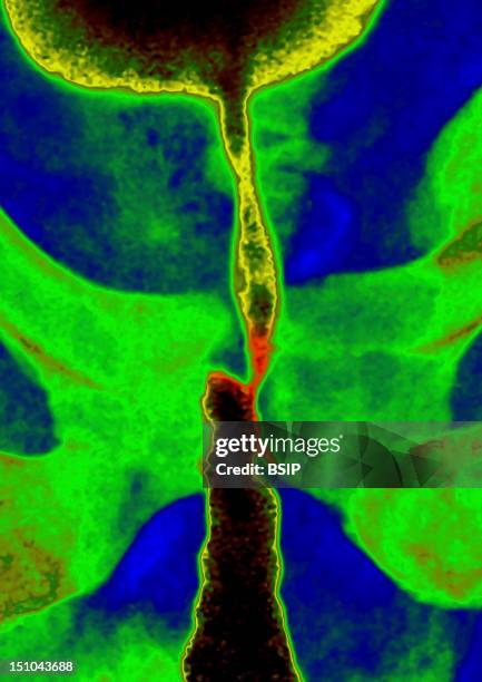 Traumatic Stenosis Of The Masculine Ureter With Urethritis, Visualized By Urography Of The Pelvis In Front View.
