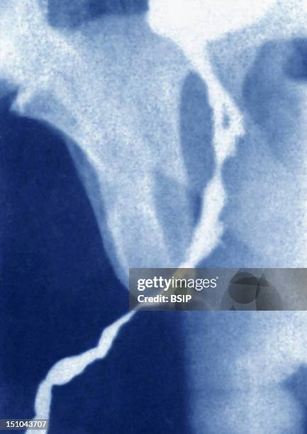 Urethritis, Visualized By Urography.