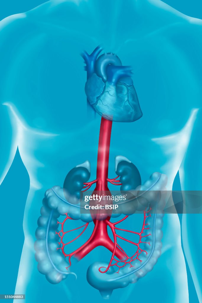 Aneurysm Of The Abdominal Aorta