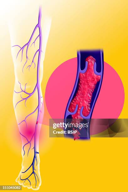 Superficial Venous Thrombosis Of The Lower Limb. The Venous Valves Are Folds Of The Veins Walls Force The Blood To Direct Unidirectionally Toward The...