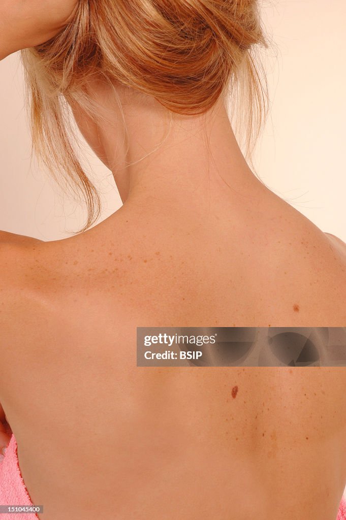 Nevus