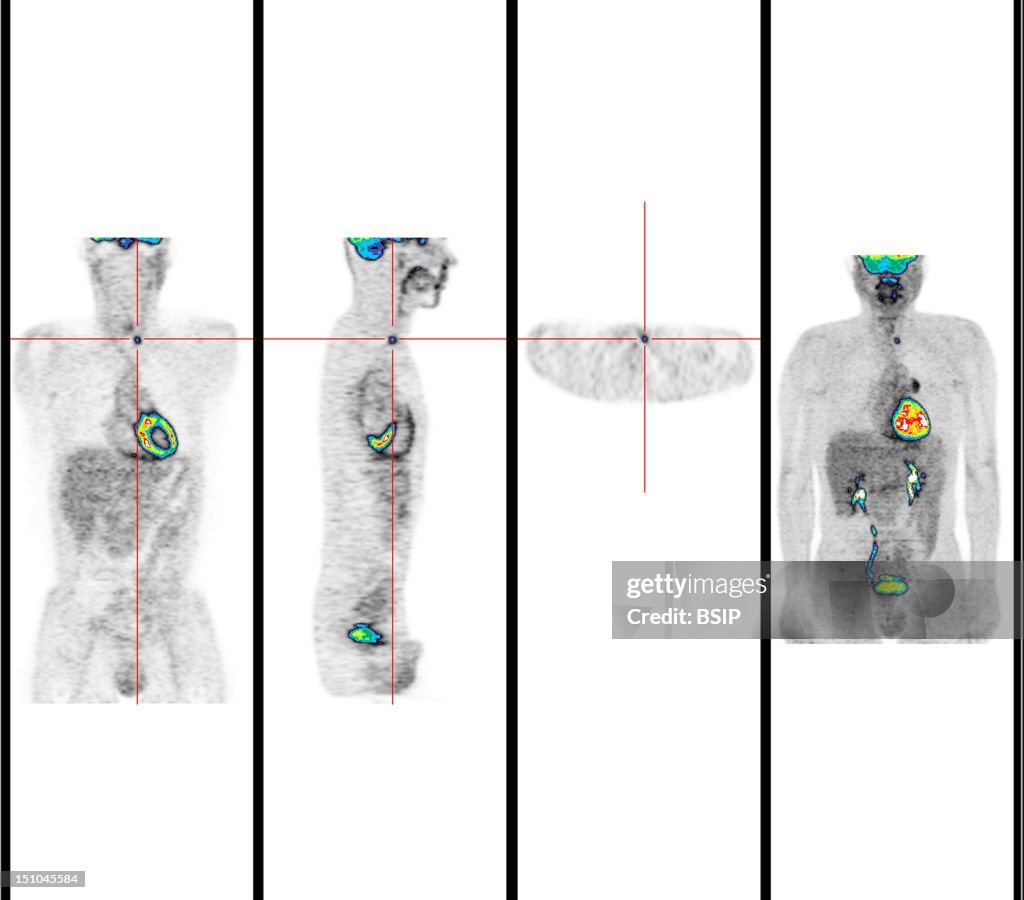 Lung Tumor