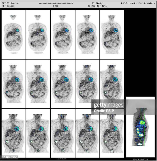 Pet Scan Rih Lung Pet Scan Photos and Premium High Res Pictures - Getty Images