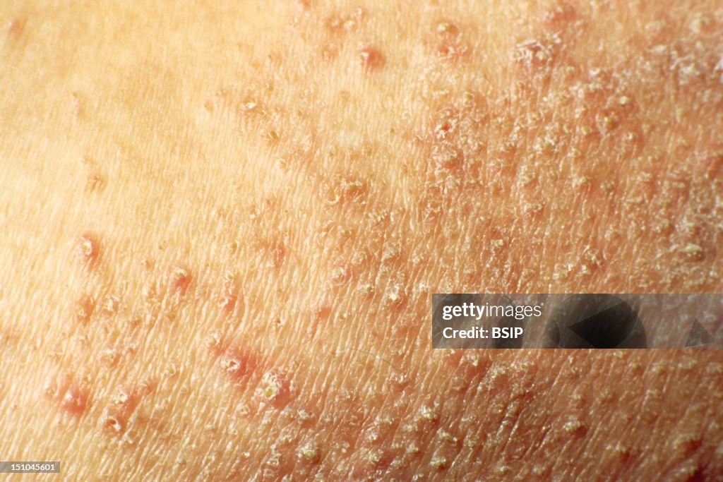 Prp Rash Pityriasis Rubra Pilaris Fotografía de noticias - Getty Images