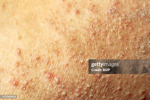 Pitris Rash Pityriasis Photos and Premium High Res Pictures - Getty Images