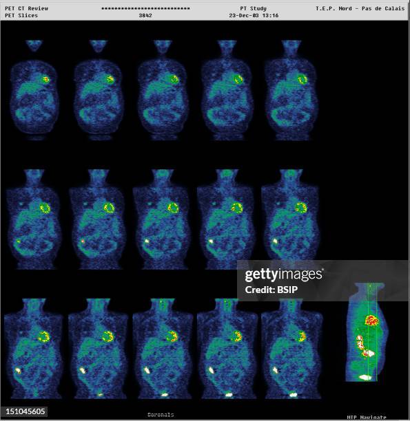 Examples Of Pet Scan 37 Lung Pet Scan Stock Photos, High-Res Pictures, and Images - Getty Images