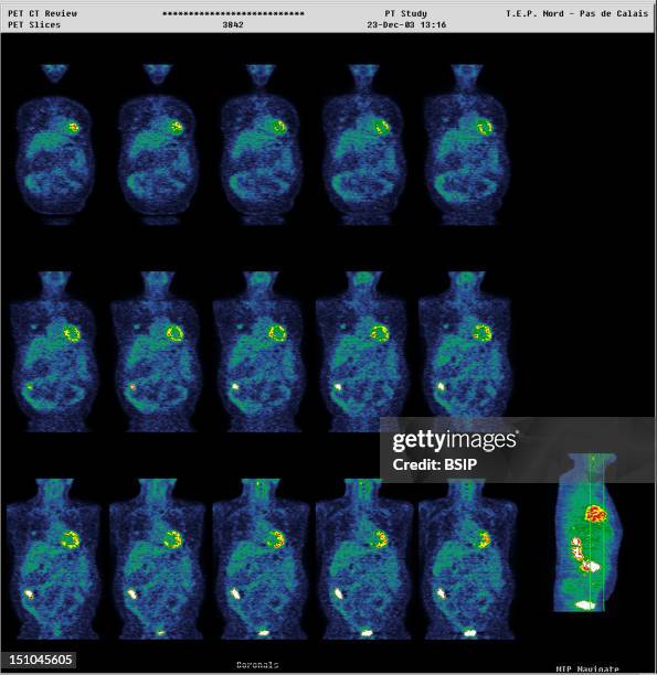 Institute Of Nuclear Medicine, University Hospital Of Lille, France. Pet Scan Positron Emission Tomography. Adenocarcinoma Right Side Of Colon, Due...