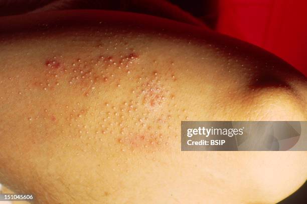 Pitris Rash Pityriasis Photos and Premium High Res Pictures - Getty Images