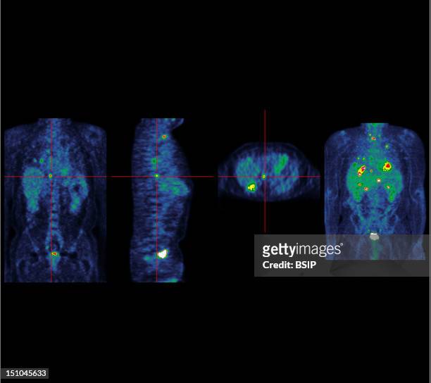 Institute Of Nuclear Medicine, University Hospital Of Lille, France. Pet Scan Positron Emission Tomography. Colorectal Carcinoma. Several Liver And...