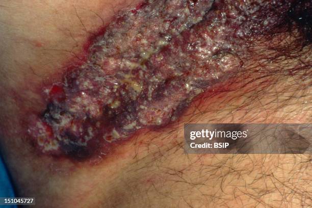 Pemphigus Vegetans