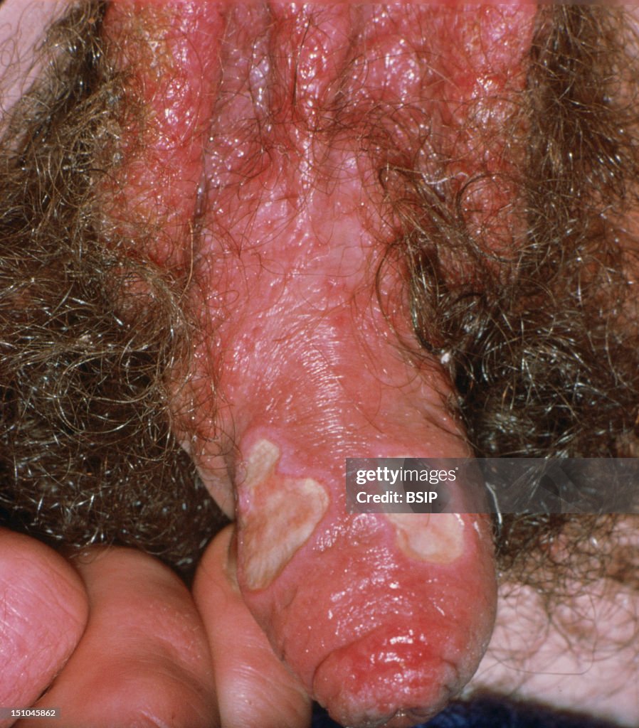 A Chancroid