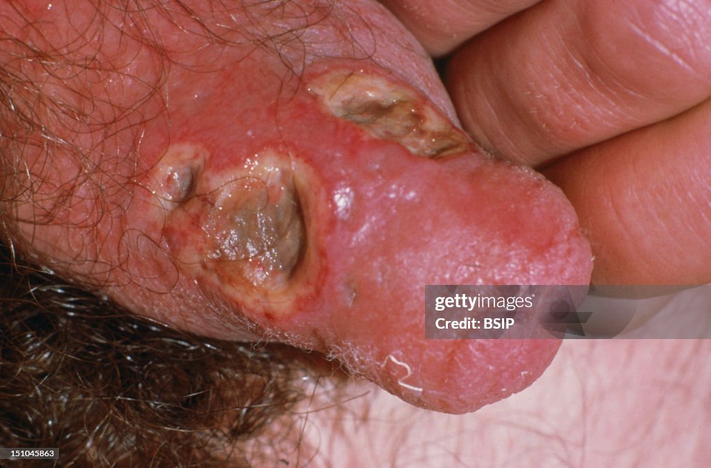 A Chancroid