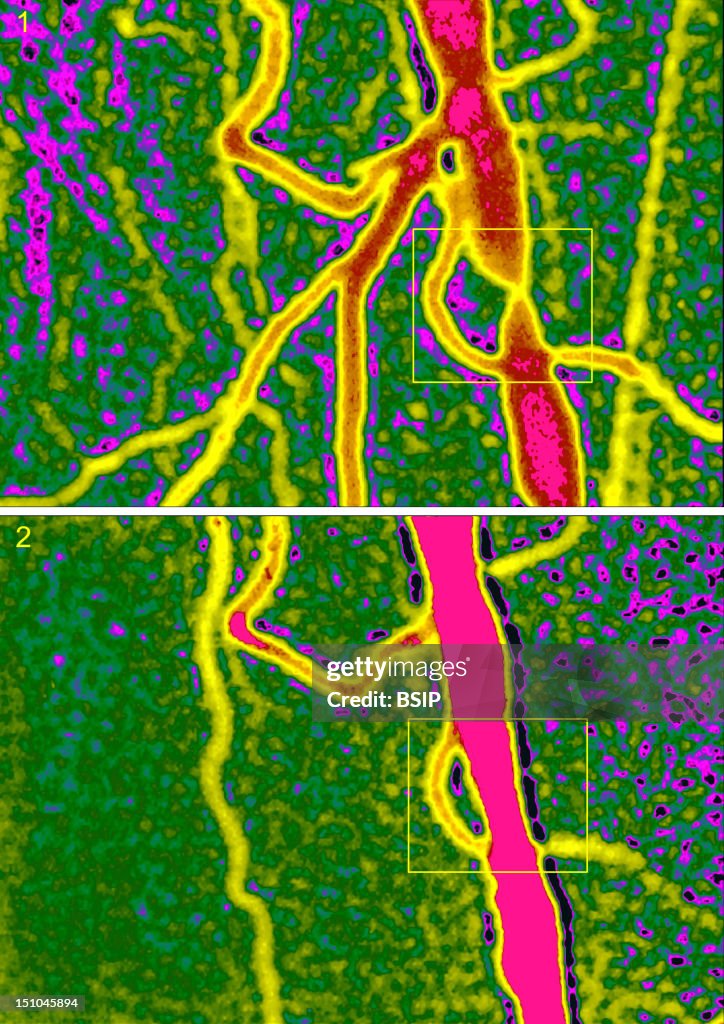 Arterial Angioplasty, Result