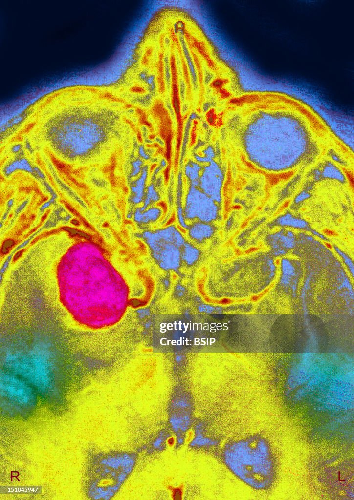 Optic Nerve Schwannoma, Mri