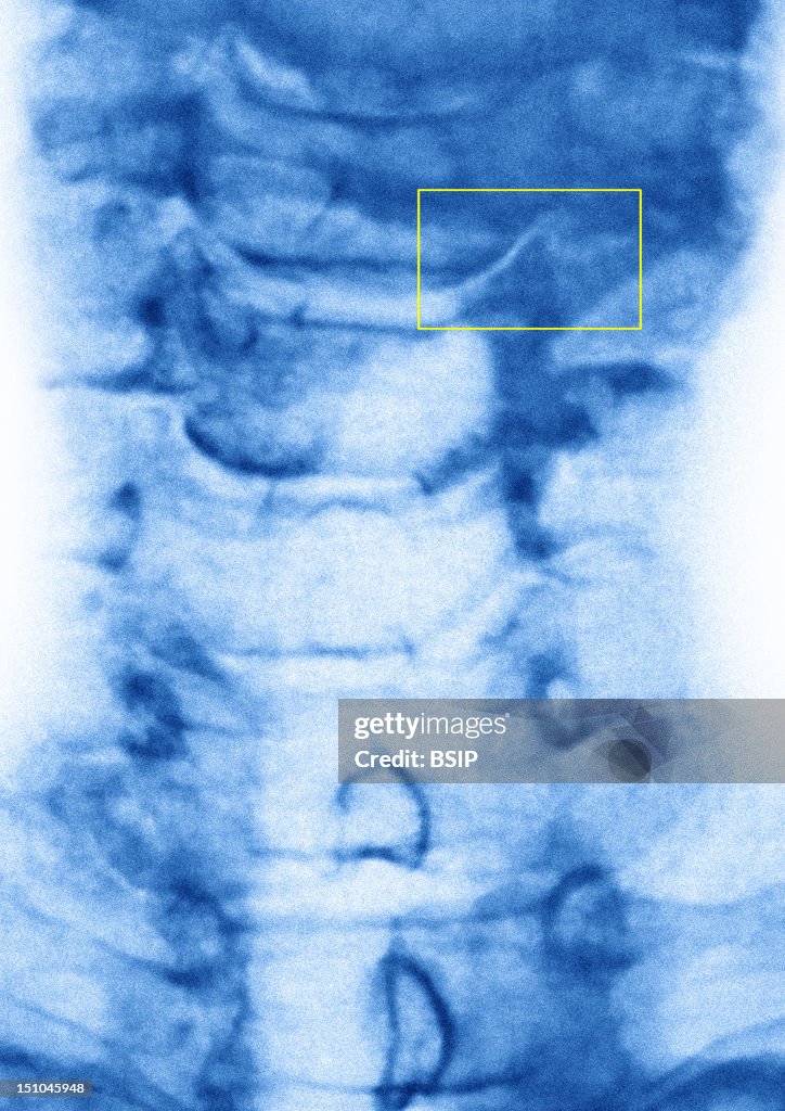 Cervical Osteoarthritis, X-Ray