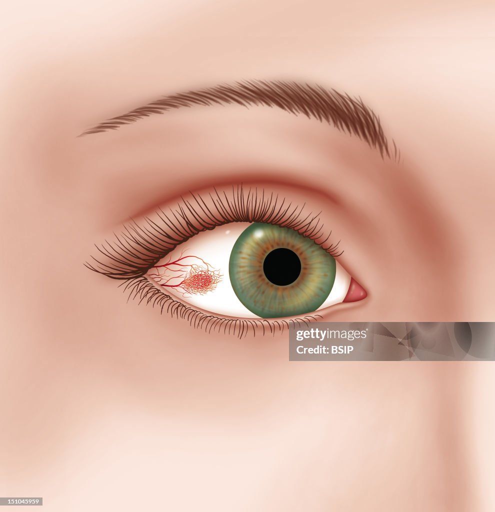 Episcleritis, Illustration