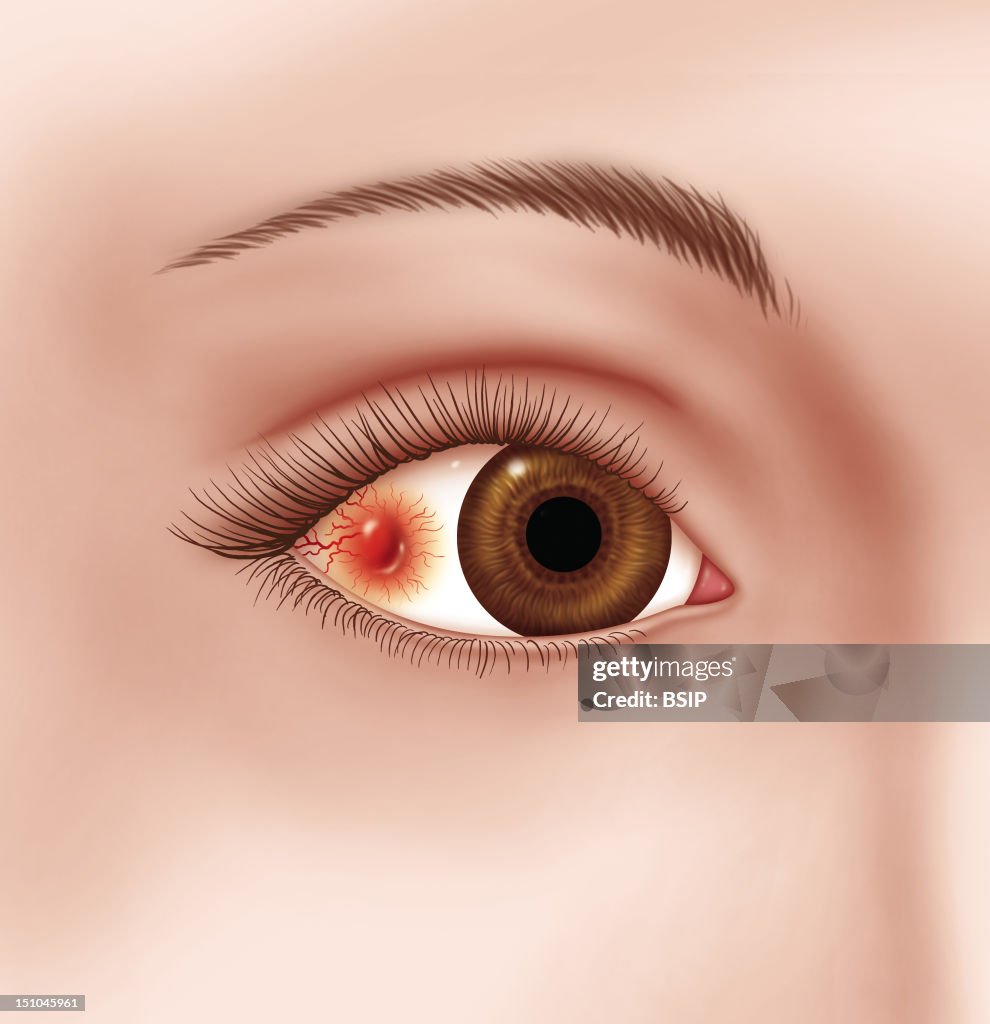Nodular Scleritis, Drawing