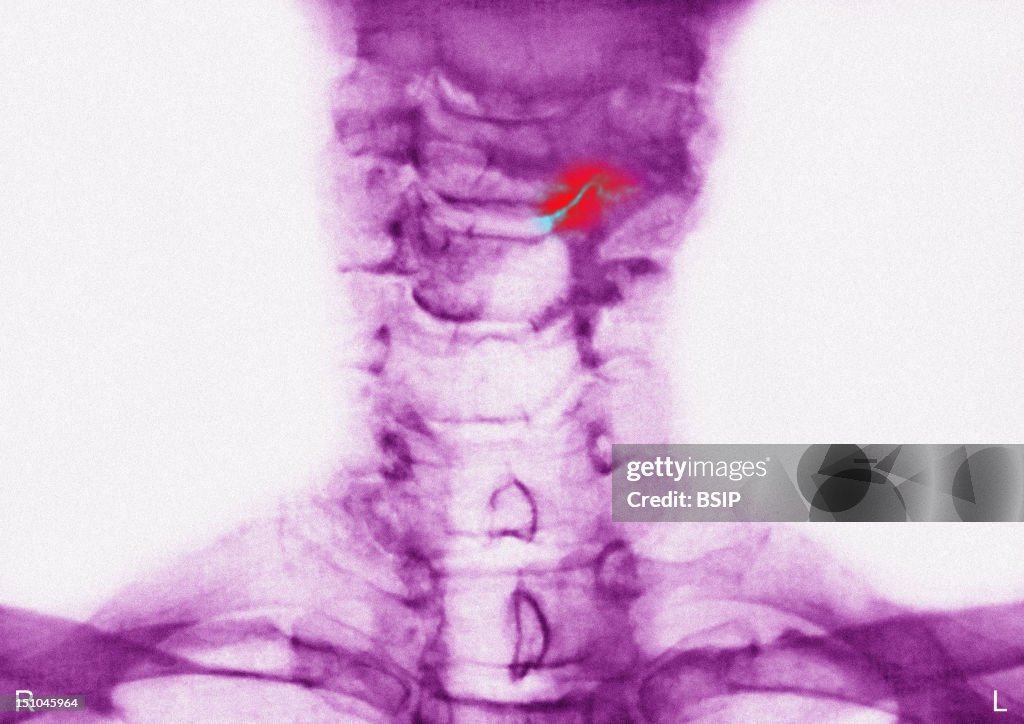 Cervical Osteoarthritis, X-Ray
