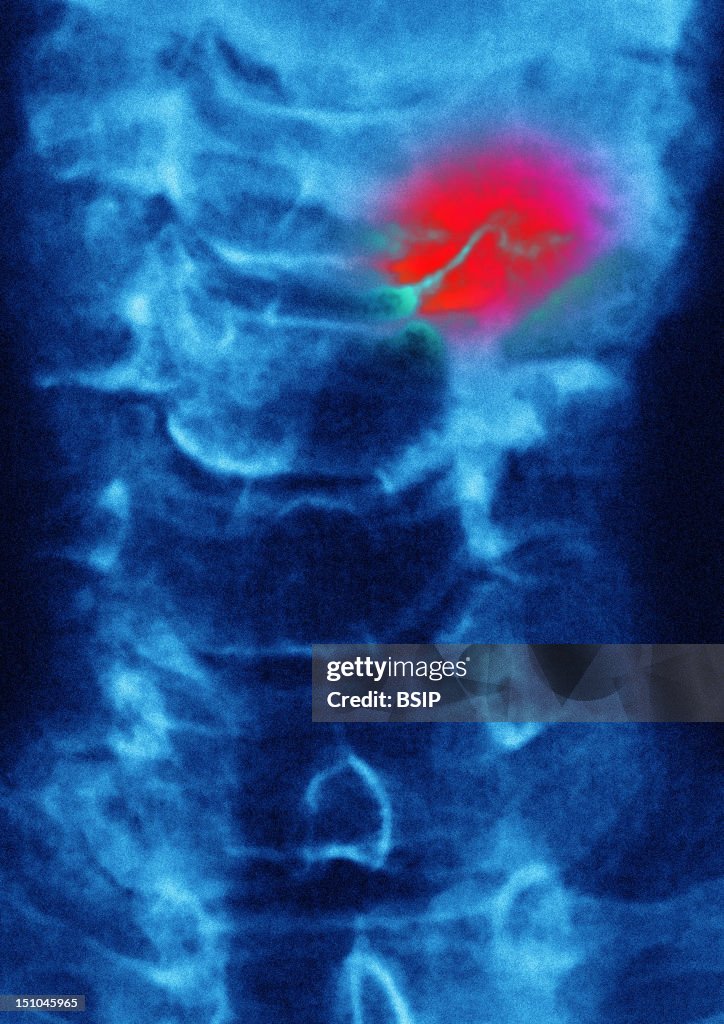 Cervical Osteoarthritis, X-Ray