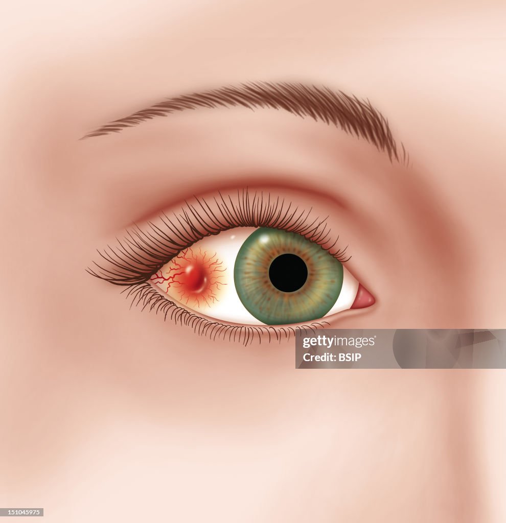 Nodular Scleritis, Drawing