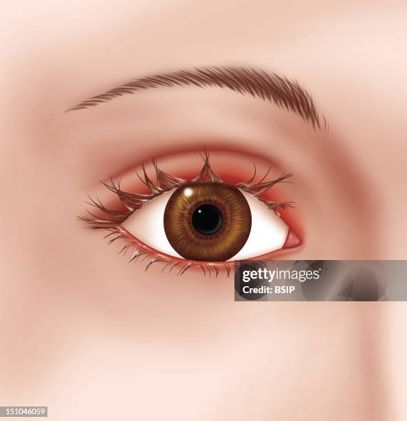 Blepharitis. Representation Of A Blepharitis, Inflammation Of The Eyelid, Of Allergic, Infectious Or Irritative Origin.