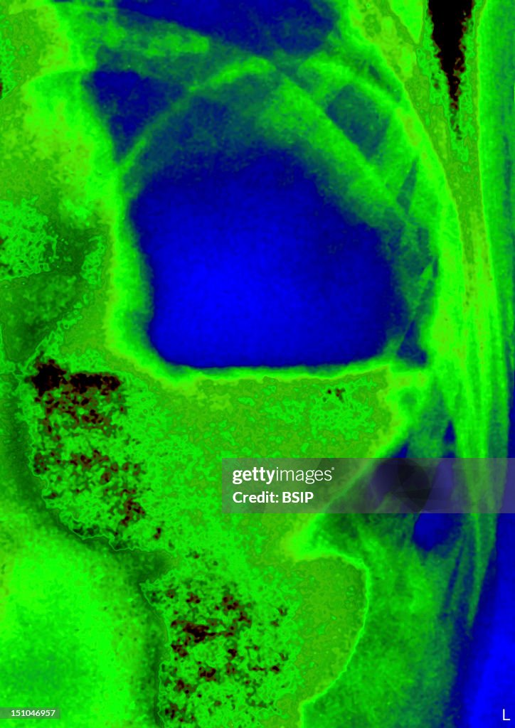 Diaphragmatic Hernia, X-Ray