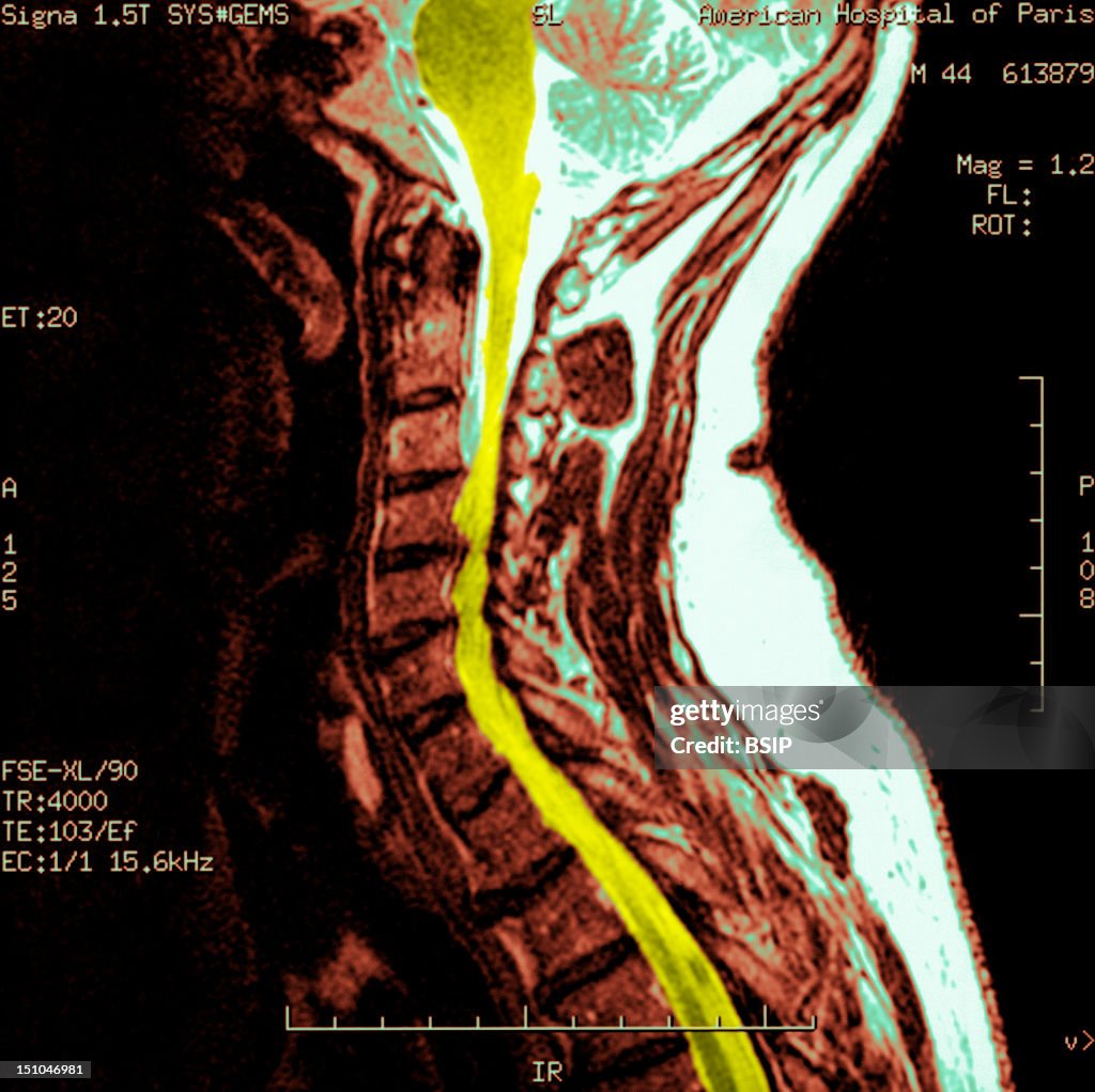 Cervical Osteoarthritis, Mri