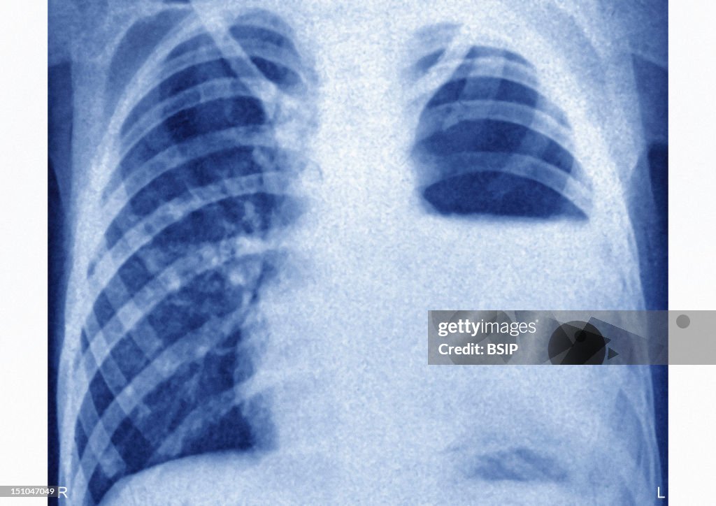 Pyothorax, X-Ray