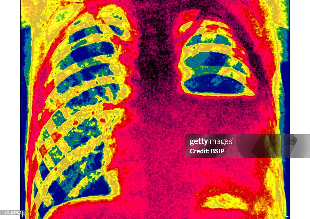 Pyothorax, X-Ray