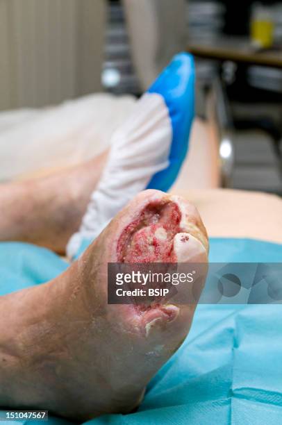 Photo Essay In The Department Of Diabetology At Saint Louis Hospital, Paris, France. Transmetatarsal Amputation On A Diabetic Foot Following A...