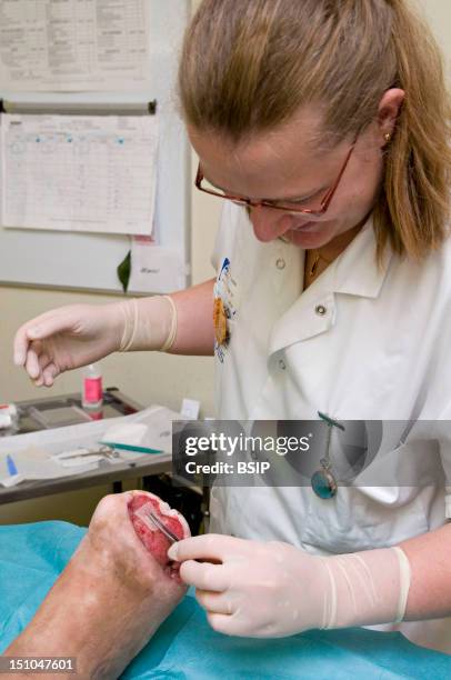 Photo Essay In The Department Of Diabetology At Saint Louis Hospital, Paris, France. Transmetatarsal Amputation On A Diabetic Foot Following A...