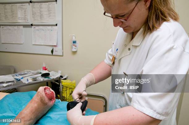 Photo Essay In The Department Of Diabetology At Saint Louis Hospital, Paris, France. Transmetatarsal Amputation On A Diabetic Foot Following A...