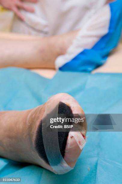 Photo Essay In The Department Of Diabetology At Saint Louis Hospital, Paris, France. Transmetatarsal Amputation On A Diabetic Foot Following A...