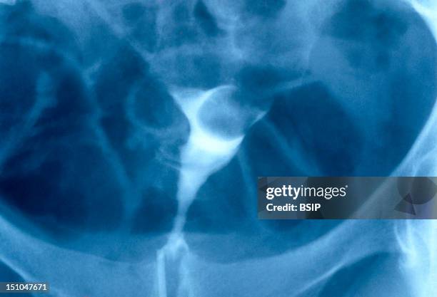 Hysterography Of A Uterine Fibroma.