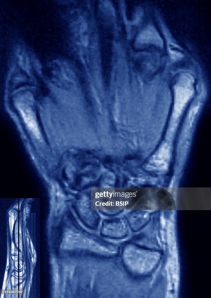 Mri Righ Hand Healthy Right Wrist Frontal Mri Of The Hand. News Photo - Getty Images