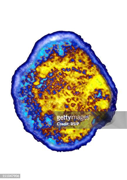 Ebv Herpesvirus Epstein Barr Virus Is Responsible For Infectious Mononucleosis And Burkitt's Lymphoma. Image Made According To A View Under...