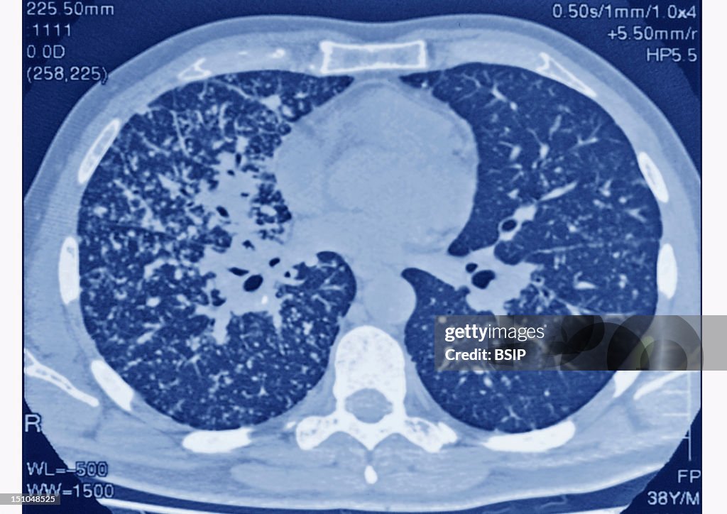 Lung Sarcoidosis, Scan