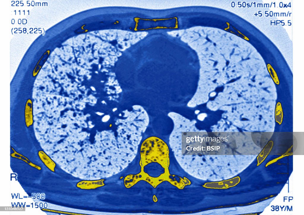 Lung Sarcoidosis, Scan