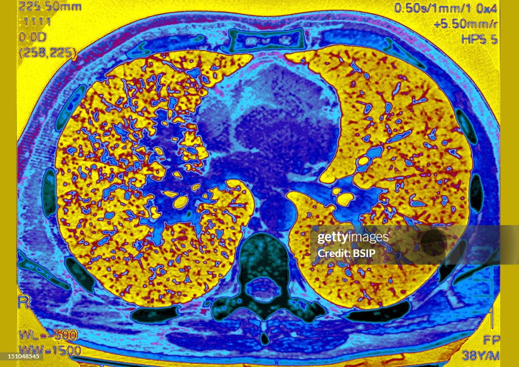Lung Sarcoidosis, Scan