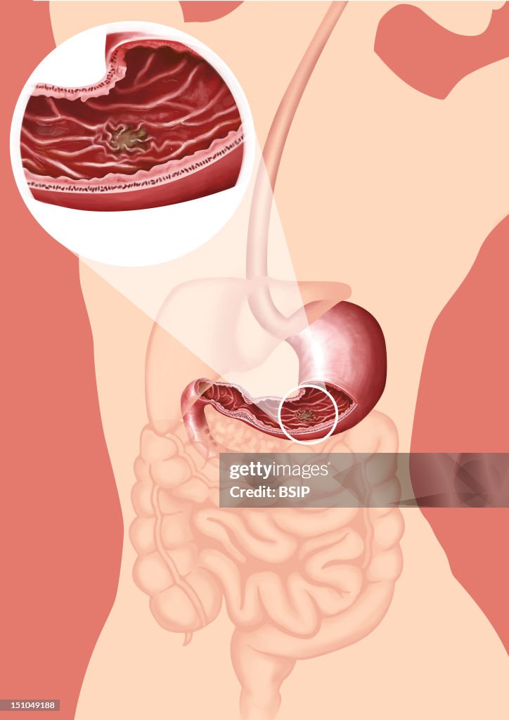 Gastric Ulcer, Drawing