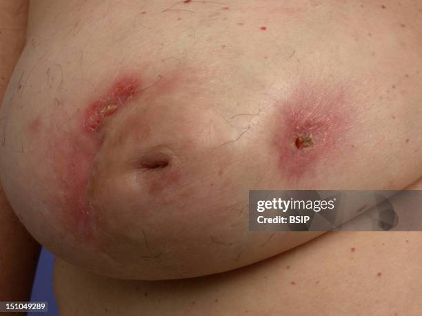 Hidradenitis Suppurativa